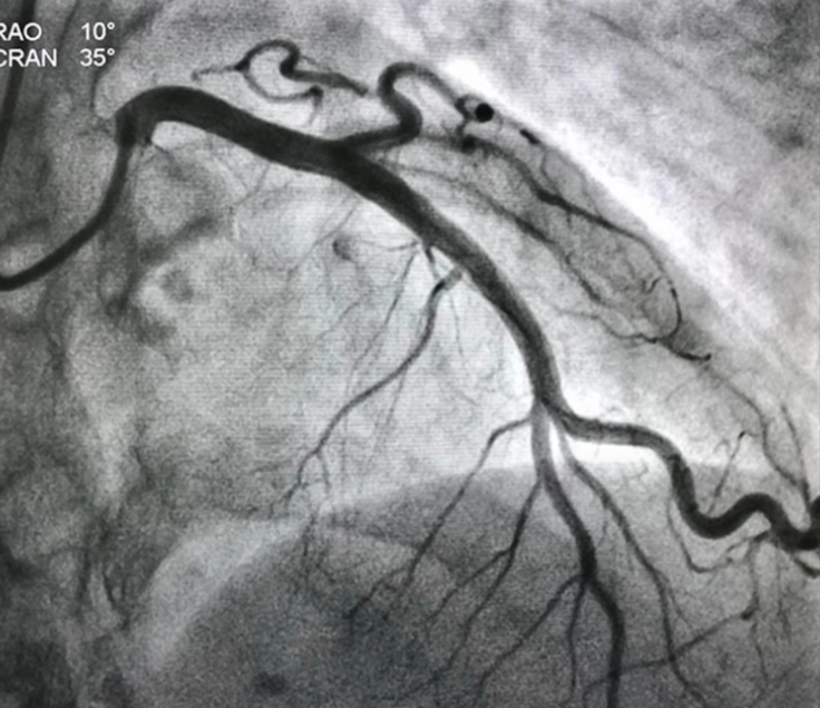Angiograms Render 1