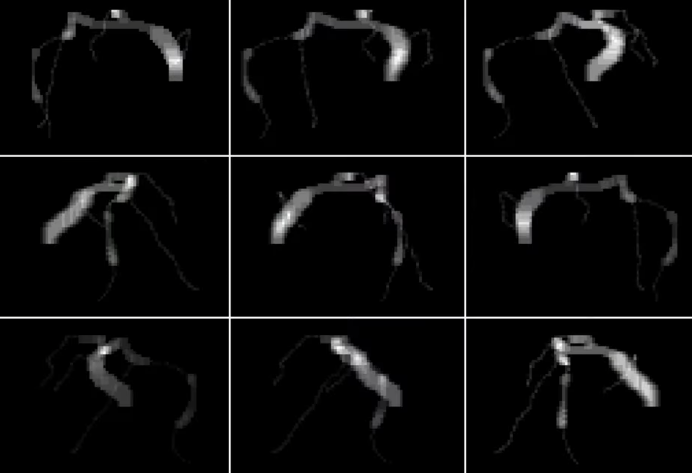 Angiograms Render 2